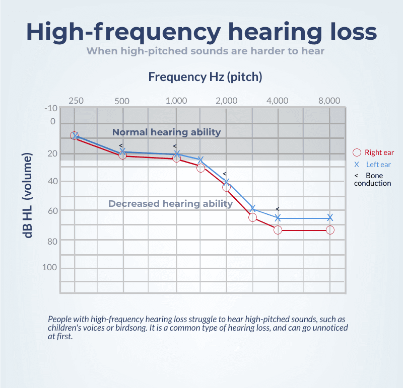 An audiogram showing high-frequencing hearing loss. 