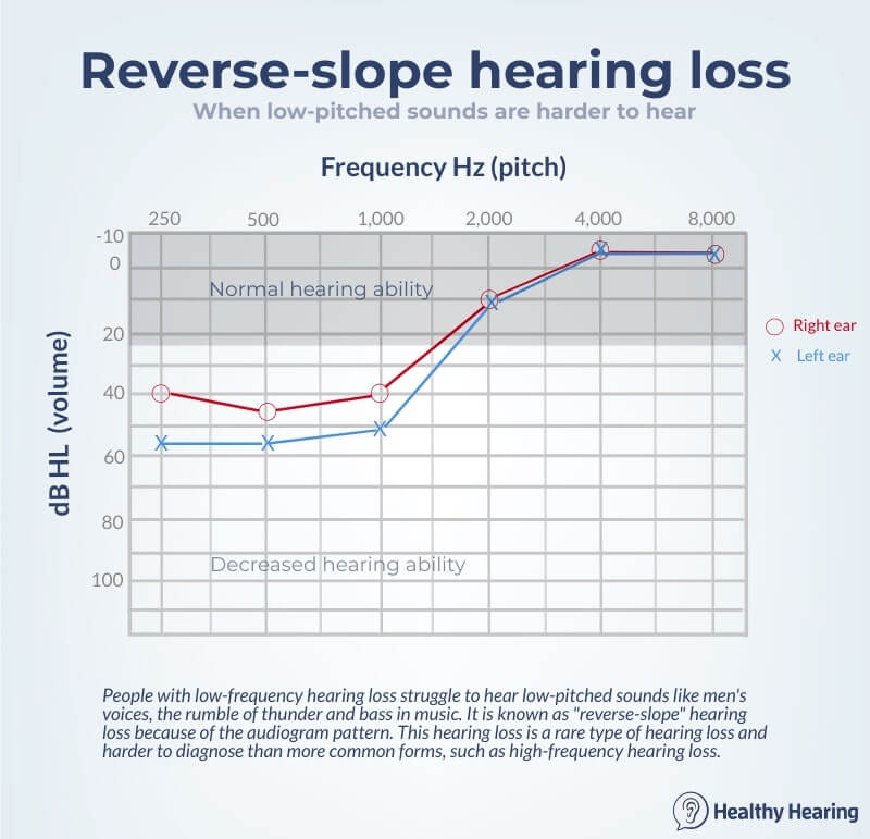 An audiogram depicting reverse-slope, low-frequency hearing loss.